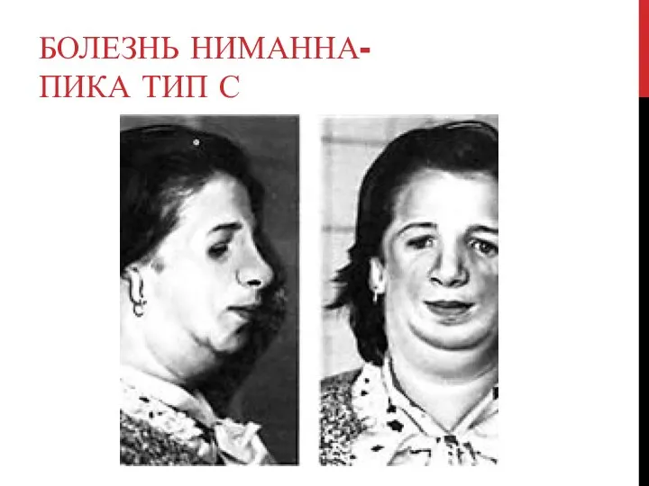 БОЛЕЗНЬ НИМАННА-ПИКА ТИП С