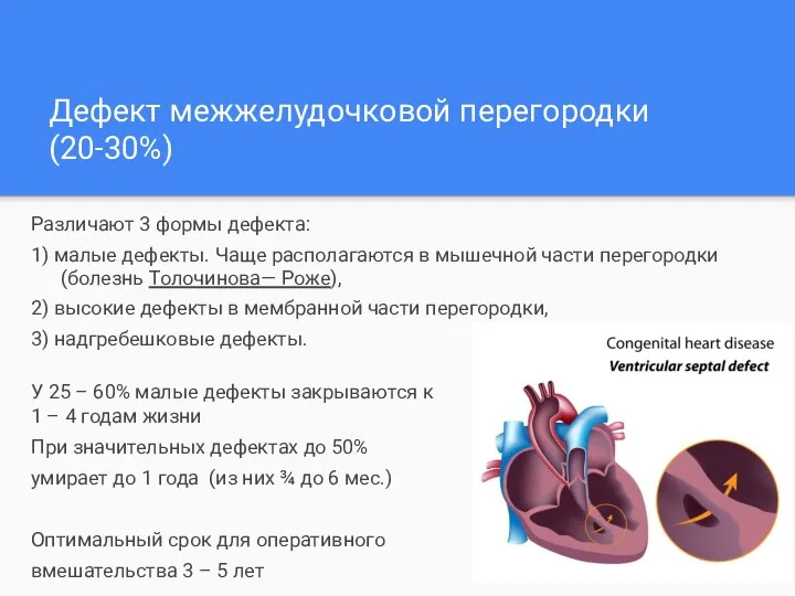 Дефект межжелудочковой перегородки (20-30%) Различают 3 формы дефекта: 1) малые дефекты. Чаще