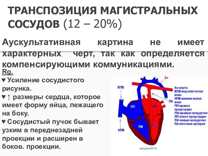 ТРАНСПОЗИЦИЯ МАГИСТРАЛЬНЫХ СОСУДОВ (12 – 20%) Аускультативная картина не имеет характерных черт,