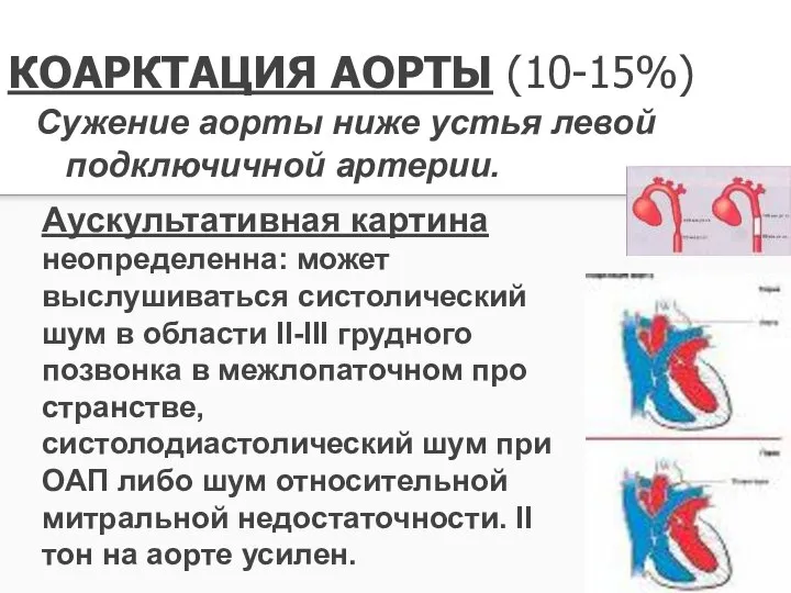 КОАРКТАЦИЯ АОРТЫ (10-15%) Сужение аорты ниже устья левой подключичной артерии. Аускультативная картина