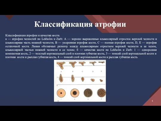 Классификация атрофии Классификации атрофии и качества кости. а — атрофии челюстей по