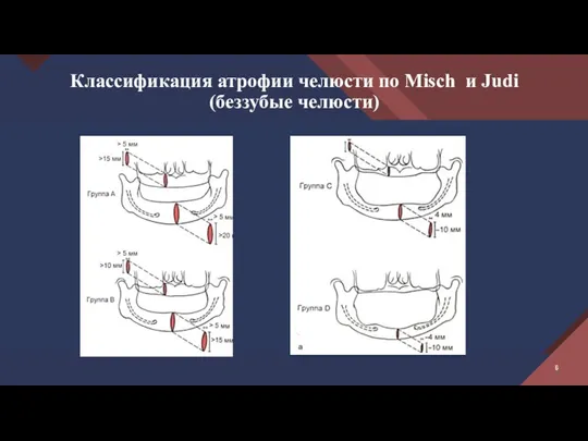 Классификация атрофии челюсти по Misch и Judi (беззубые челюсти)