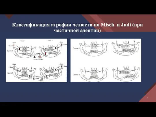 Классификация атрофии челюсти по Misch и Judi (при частичной адентии)