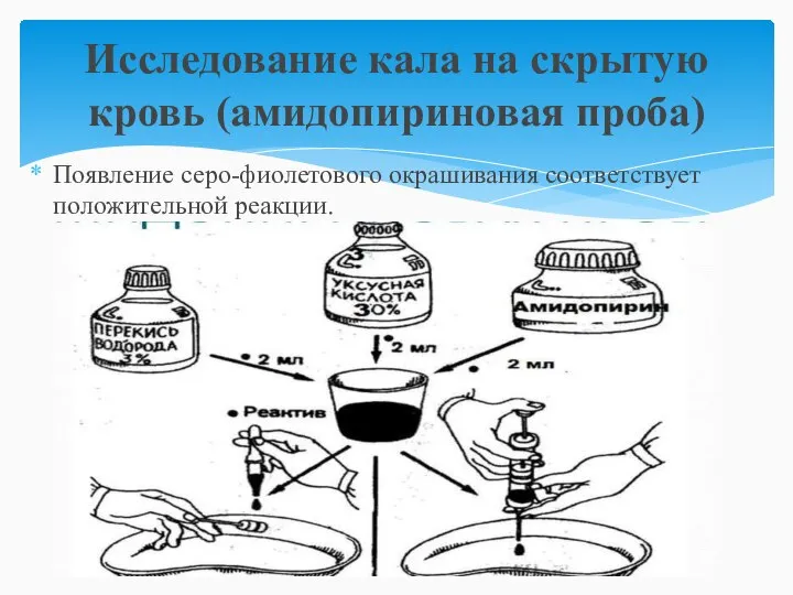 Появление серо-фиолетового окрашивания соответствует положительной реакции. Исследование кала на скрытую кровь (амидопириновая проба)