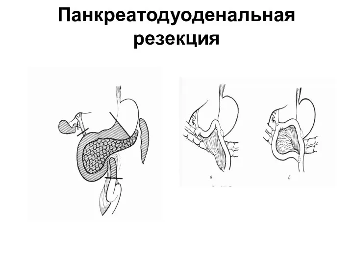 Панкреатодуоденальная резекция