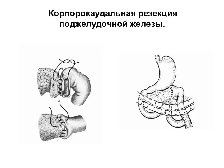 Корпорокаудальная резекция поджелудочной железы.