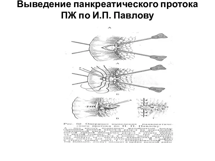 Выведение панкреатического протока ПЖ по И.П. Павлову