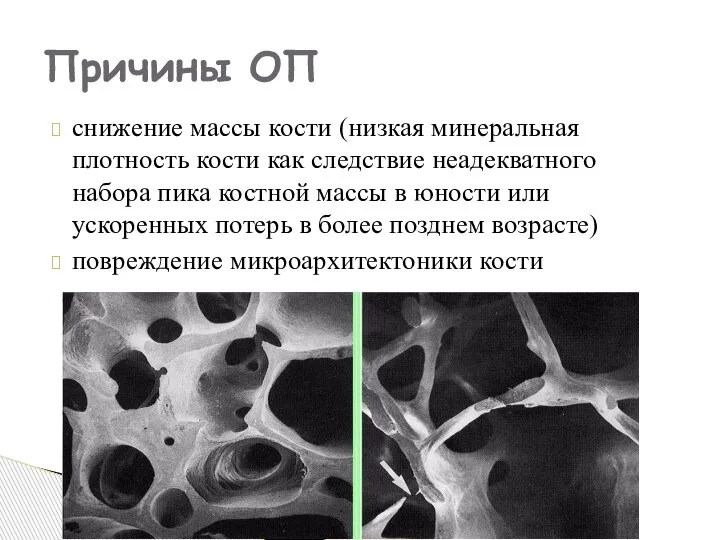 снижение массы кости (низкая минеральная плотность кости как следствие неадекватного набора пика