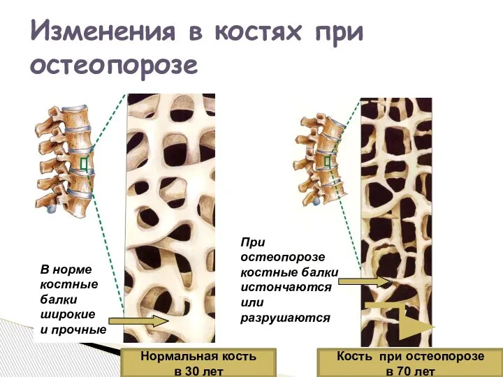 Изменения в костях при остеопорозе При остеопорозе костные балки истончаются или разрушаются