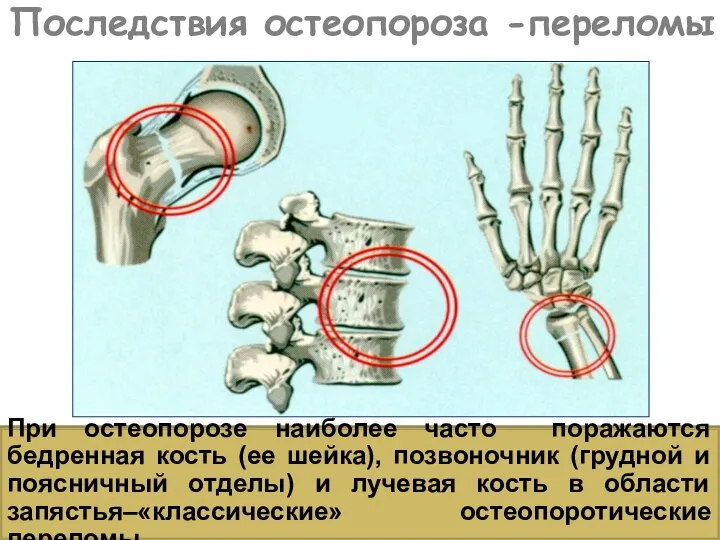 Последствия остеопороза -переломы При остеопорозе наиболее часто поражаются бедренная кость (ее шейка),