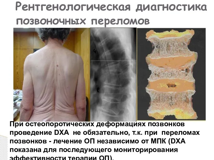 Рентгенологическая диагностика позвоночных переломов При остеопоротических деформациях позвонков проведение DXA не обязательно,