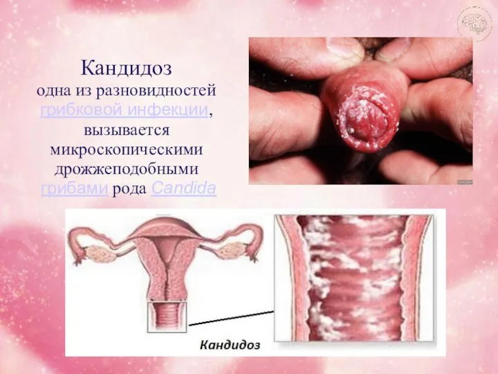 Кандидоз одна из разновидностей грибковой инфекции, вызывается микроскопическими дрожжеподобными грибами рода Candida