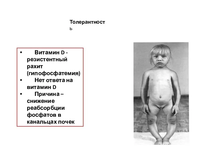 Витамин D -резистентный рахит (гипофосфатемия) Нет ответа на витамин D Причина –