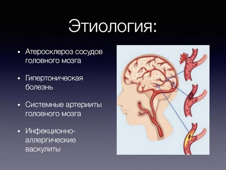 Этиология: Атеросклероз сосудов головного мозга Гипертоническая болезнь Системные артерииты головного мозга Инфекционно-аллергические васкулиты