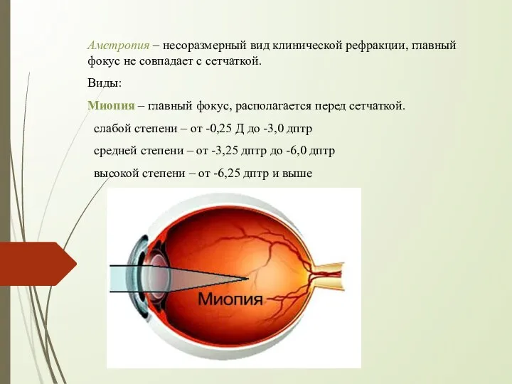 Аметропия – несоразмерный вид клинической рефракции, главный фокус не совпадает с сетчаткой.