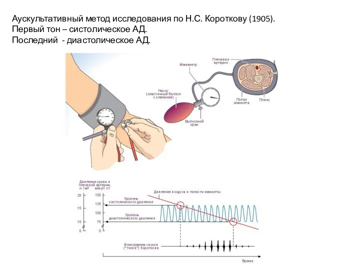 Аускультативный метод исследования по Н.С. Короткову (1905). Первый тон – систолическое АД. Последний - диастолическое АД.