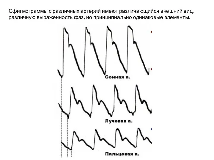 Сфигмограммы с различных артерий имеют различающийся внешний вид, различную выраженность фаз, но принципиально одинаковые элементы.