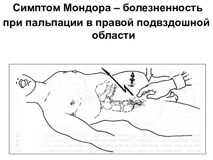 Симптом Мондора – болезненность при пальпации в правой подвздошной области