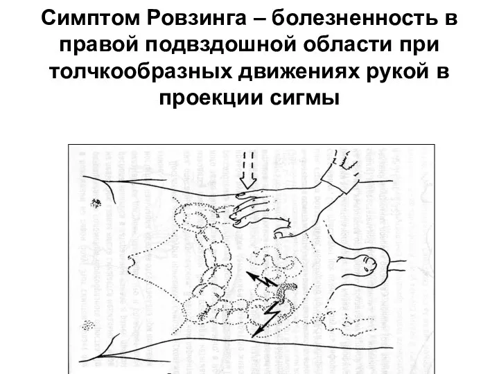 Симптом Ровзинга – болезненность в правой подвздошной области при толчкообразных движениях рукой в проекции сигмы