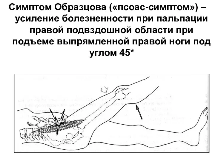 Симптом Образцова («псоас-симптом») – усиление болезненности при пальпации правой подвздошной области при