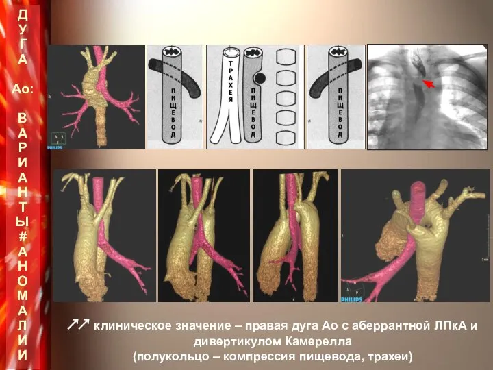 ↗↗ клиническое значение – правая дуга Ао с аберрантной ЛПкА и дивертикулом