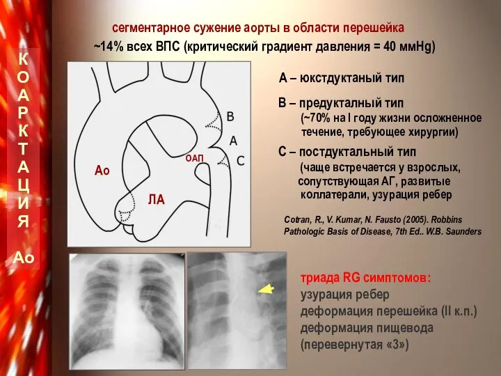 К О А Р К Т А Ц И Я Ао сегментарное