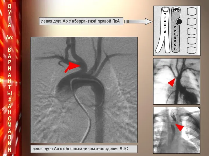 левая дуга Ао с обычным типом отхождения БЦС левая дуга Ао с