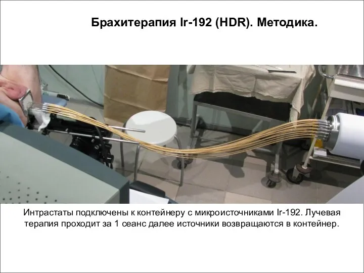 Брахитерапия Ir-192 (HDR). Методика. Интрастаты подключены к контейнеру с микроисточниками Ir-192. Лучевая
