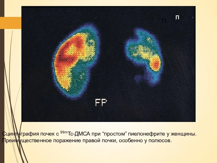 Сцинтиграфия почек с 99mTc-ДМСА при “простом” пиелонефрите у женщины. Преимущественное поражение правой