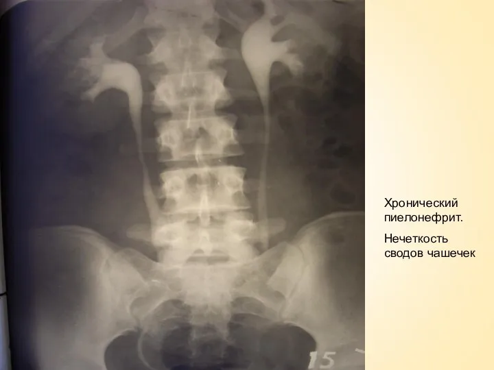 Хронический пиелонефрит. Нечеткость сводов чашечек