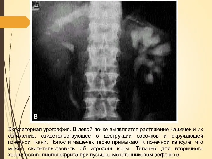 Экскреторная урография. В левой почке выявляется растяжение чашечек и их сближение, свидетельствующее