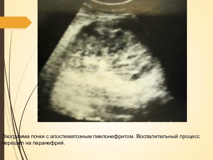 Эхограмма почки с апостематозным пиелонефритом. Воспалительный процесс перешел на паранефрий.