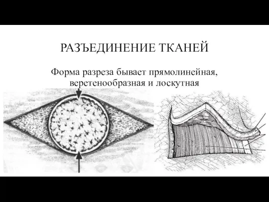 РАЗЪЕДИНЕНИЕ ТКАНЕЙ Форма разреза бывает прямолинейная, веретенообразная и лоскутная