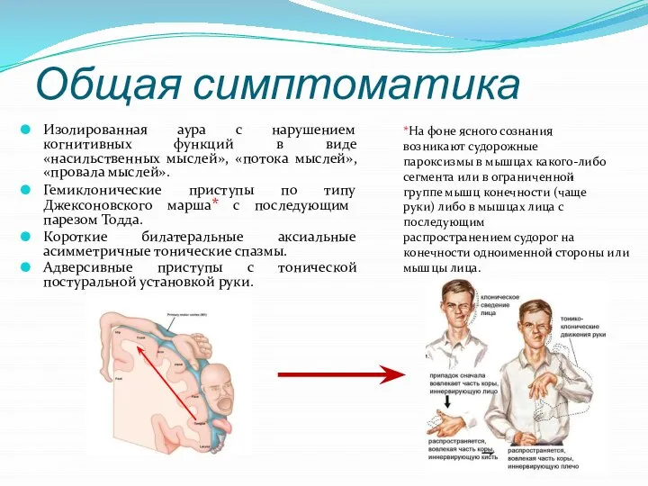 Общая симптоматика Изолированная аура с нарушением когнитивных функций в виде «насильственных мыслей»,