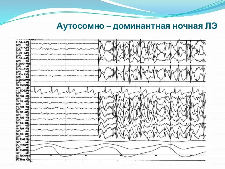 Аутосомно – доминантная ночная ЛЭ