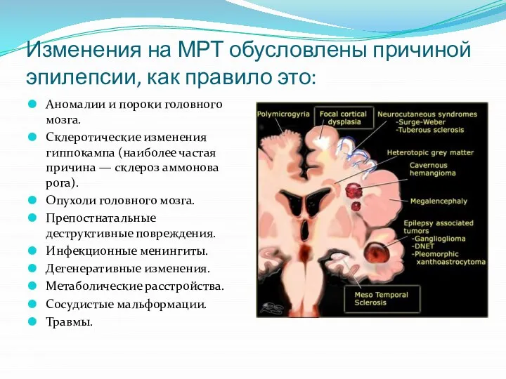 Изменения на МРТ обусловлены причиной эпилепсии, как правило это: Аномалии и пороки