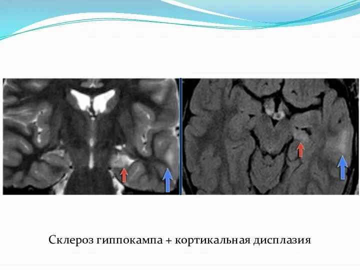 Склероз гиппокампа + кортикальная дисплазия