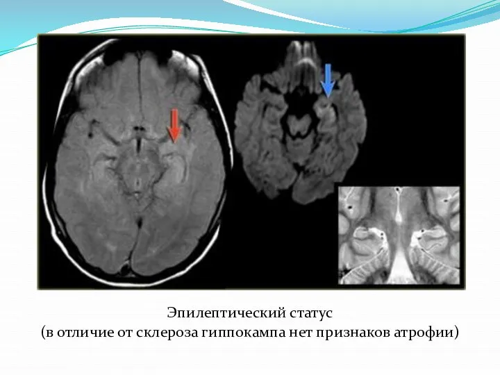 Эпилептический статус (в отличие от склероза гиппокампа нет признаков атрофии)