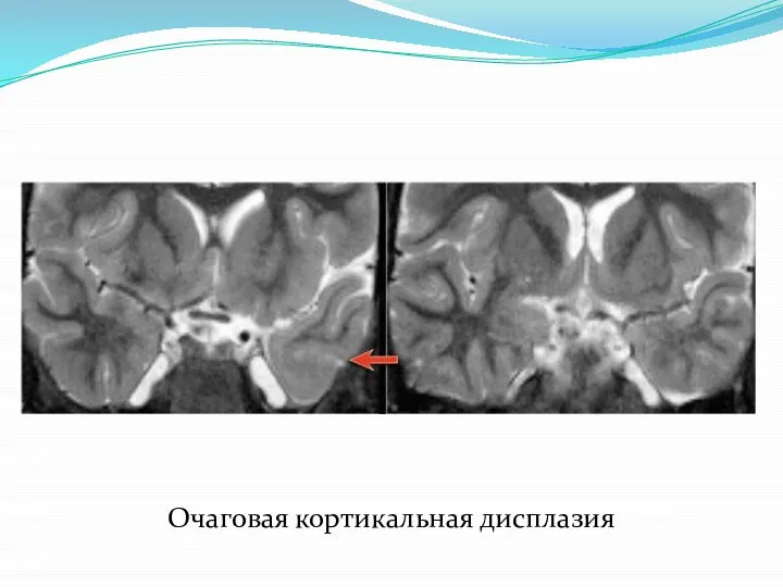 Очаговая кортикальная дисплазия