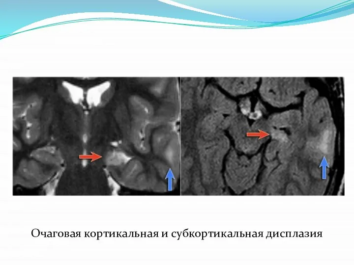 Очаговая кортикальная и субкортикальная дисплазия