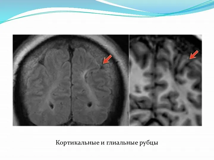 Кортикальные и глиальные рубцы