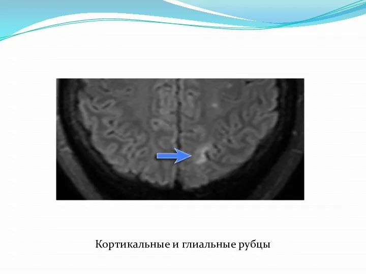 Кортикальные и глиальные рубцы