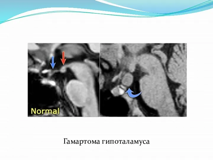 Гамартома гипоталамуса