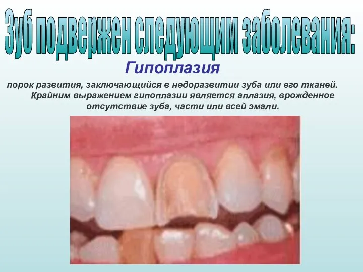 Гипоплазия порок развития, заключающийся в недоразвитии зуба или его тканей. Крайним выражением