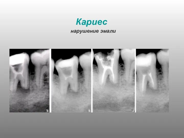 Кариес нарушение эмали