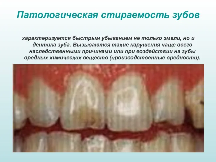 Патологическая стираемость зубов характеризуется быстрым убыванием не только эмали, но и дентина