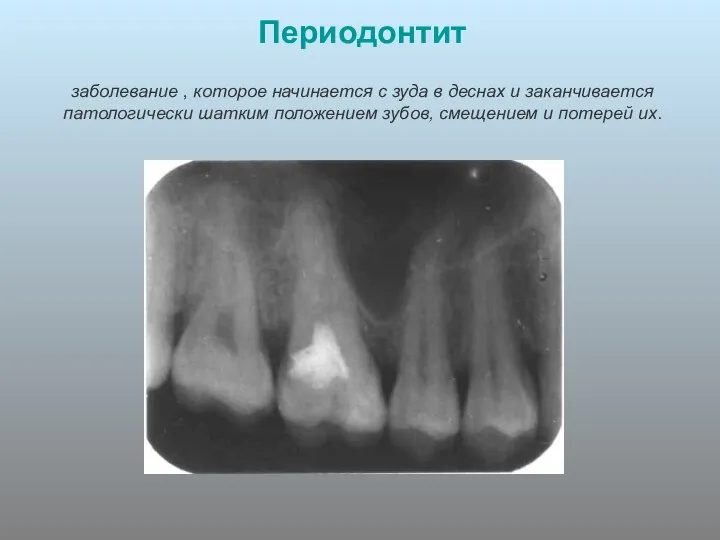 Периодонтит заболевание , которое начинается с зуда в деснах и заканчивается патологически