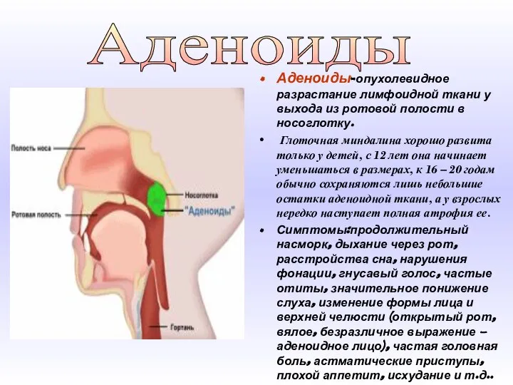 Аденоиды-опухолевидное разрастание лимфоидной ткани у выхода из ротовой полости в носоглотку. Глоточная