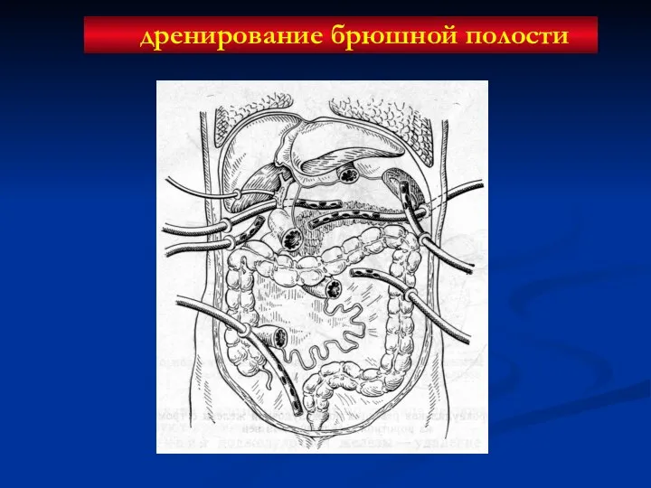 дренирование брюшной полости