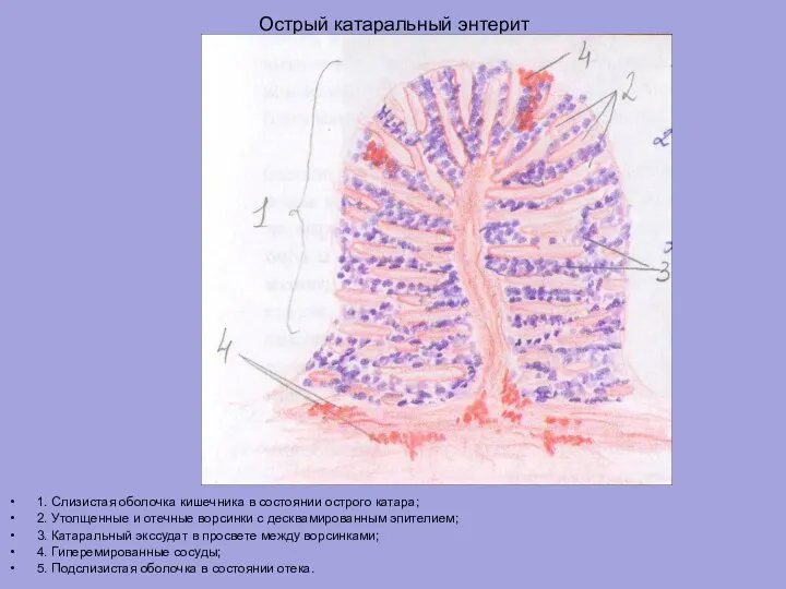 Острый катаральный энтерит 1. Слизистая оболочка кишечника в состоянии острого катара; 2.
